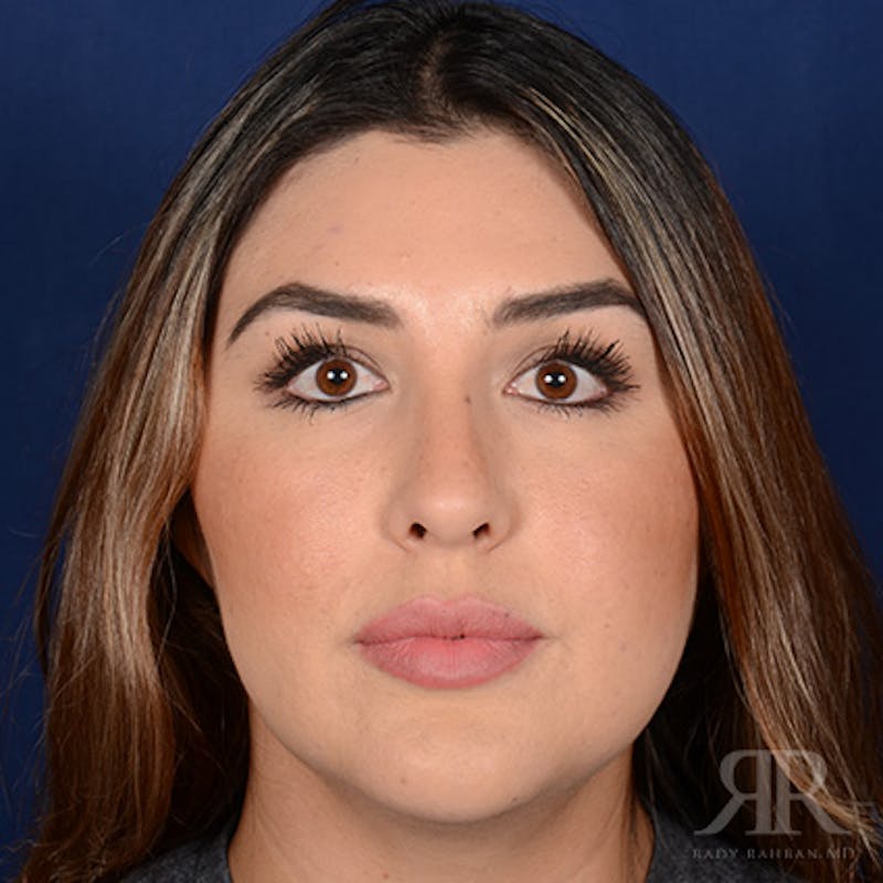 Female Rhinoplasty Before & After Gallery - Patient 286742 - Image 1