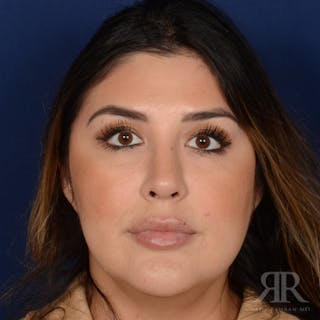 Female Rhinoplasty Before & After Gallery - Patient 286742 - Image 2