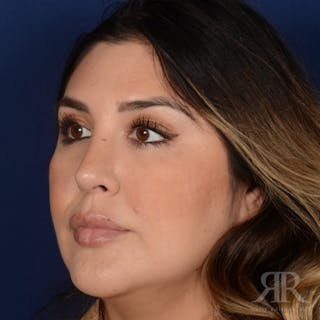 Female Rhinoplasty Before & After Gallery - Patient 286742 - Image 4