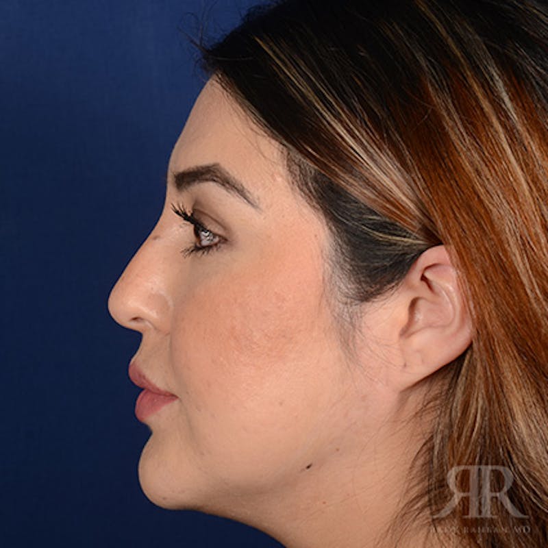 Female Rhinoplasty Before & After Gallery - Patient 286742 - Image 5
