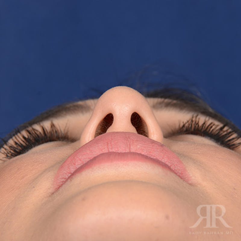 Female Rhinoplasty Before & After Gallery - Patient 286742 - Image 7
