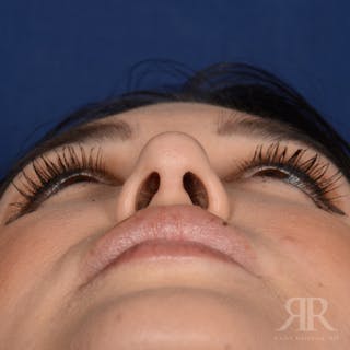 Female Rhinoplasty Before & After Gallery - Patient 286742 - Image 8