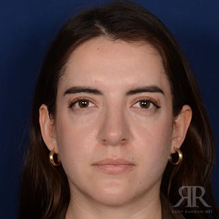 Female Rhinoplasty Before & After Gallery - Patient 366788 - Image 2