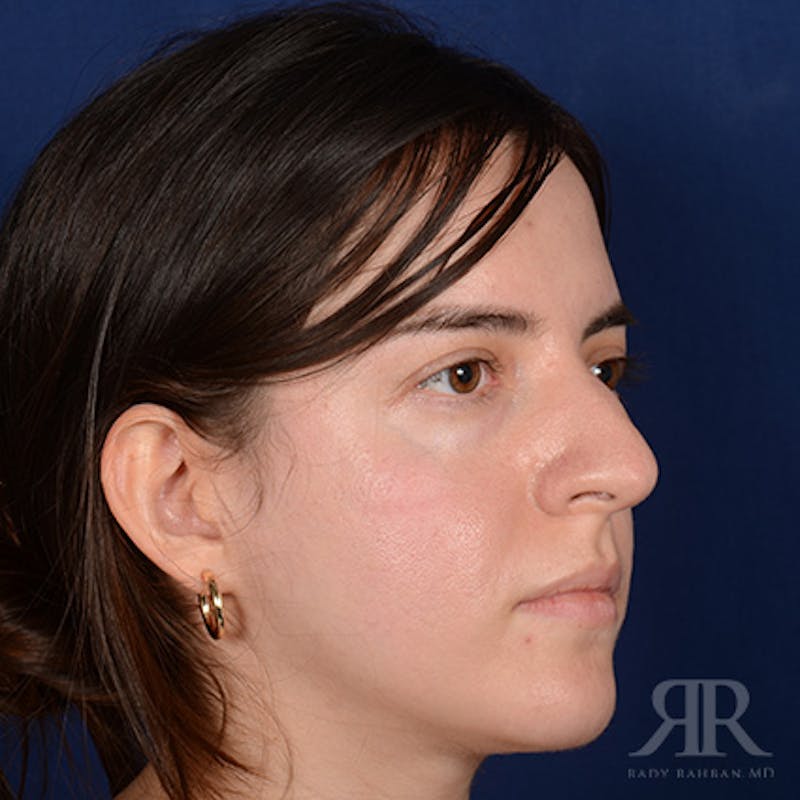 Female Rhinoplasty Before & After Gallery - Patient 366788 - Image 3