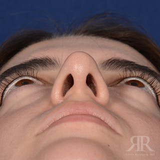 Female Rhinoplasty Before & After Gallery - Patient 366788 - Image 8