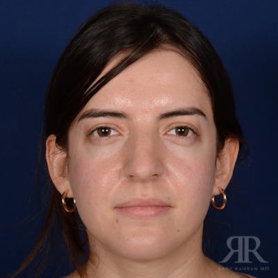 Female Rhinoplasty Before & After Gallery - Patient 366788 - Image 1