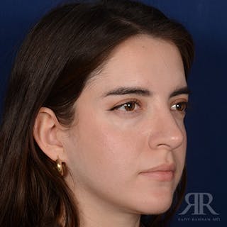 Female Rhinoplasty Before & After Gallery - Patient 366788 - Image 4
