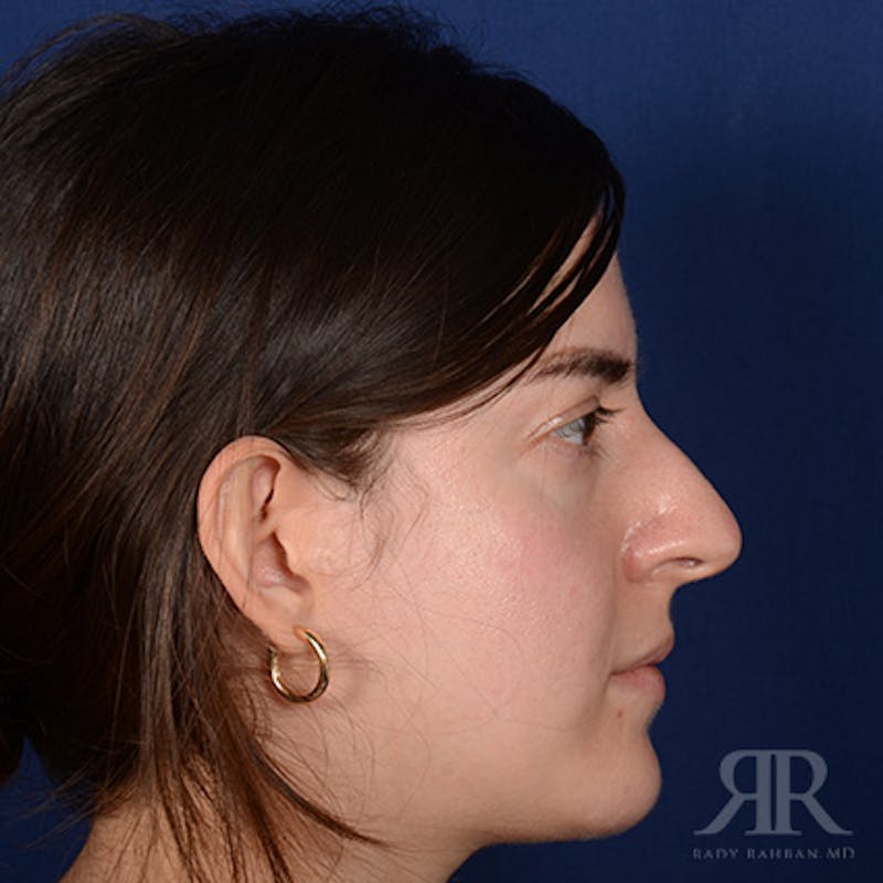 Female Rhinoplasty Before & After Gallery - Patient 366788 - Image 5