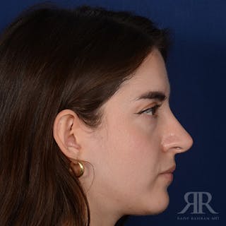 Female Rhinoplasty Before & After Gallery - Patient 366788 - Image 6