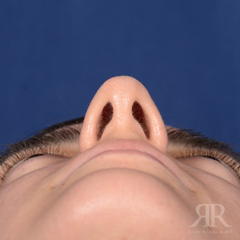 Female Rhinoplasty Before & After Gallery - Patient 366788 - Image 7