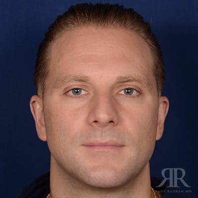 Male Rhinoplasty Before & After Gallery - Patient 132800 - Image 1