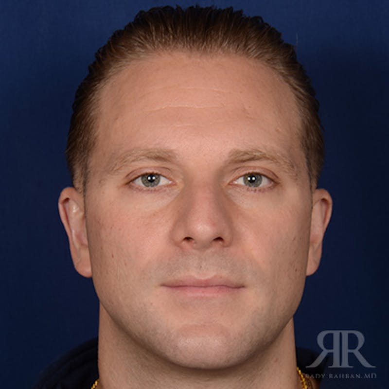 Male Rhinoplasty Before & After Gallery - Patient 132800 - Image 1