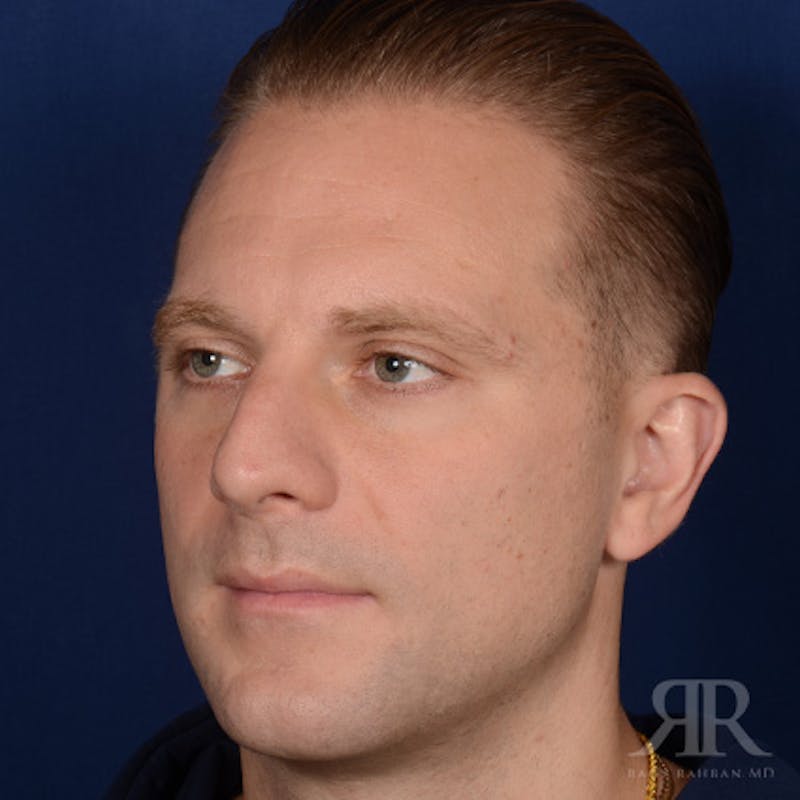 Male Rhinoplasty Before & After Gallery - Patient 132800 - Image 3