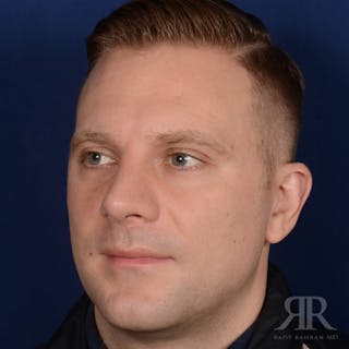 Male Rhinoplasty Before & After Gallery - Patient 132800 - Image 4