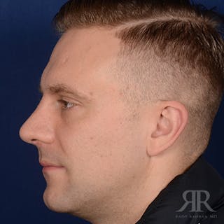Male Rhinoplasty Before & After Gallery - Patient 132800 - Image 6