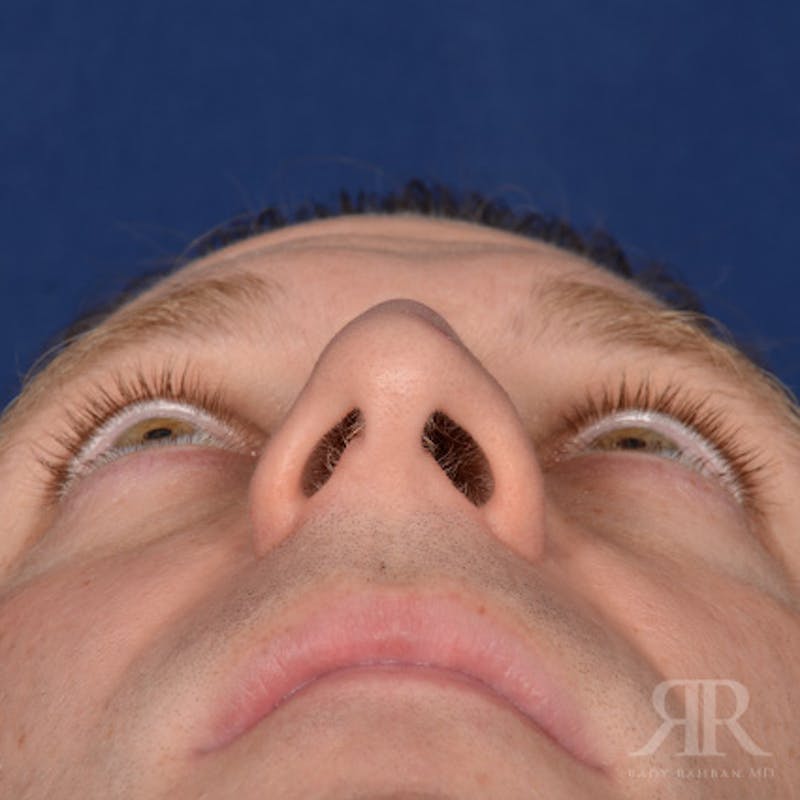 Male Rhinoplasty Before & After Gallery - Patient 132800 - Image 7