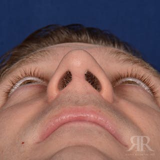 Male Rhinoplasty Before & After Gallery - Patient 132800 - Image 8