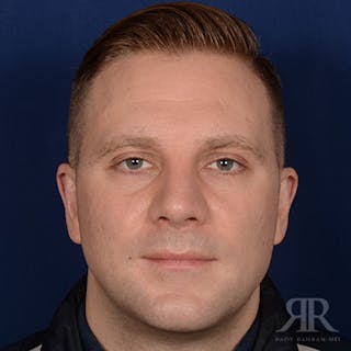 Male Rhinoplasty Before & After Gallery - Patient 132800 - Image 2