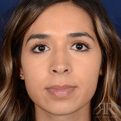 Female Rhinoplasty Before & After Gallery - Patient 180013 - Image 1