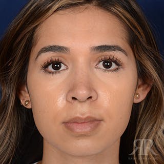 Female Rhinoplasty Before & After Gallery - Patient 180013 - Image 2