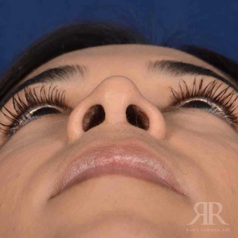 Female Rhinoplasty Before & After Gallery - Patient 180013 - Image 7