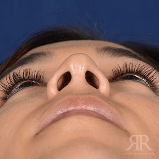 Female Rhinoplasty Before & After Gallery - Patient 180013 - Image 8