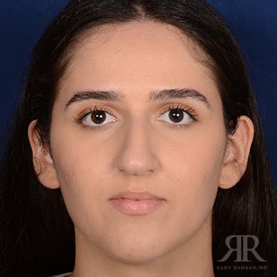 Female Rhinoplasty Before & After Gallery - Patient 314356 - Image 1