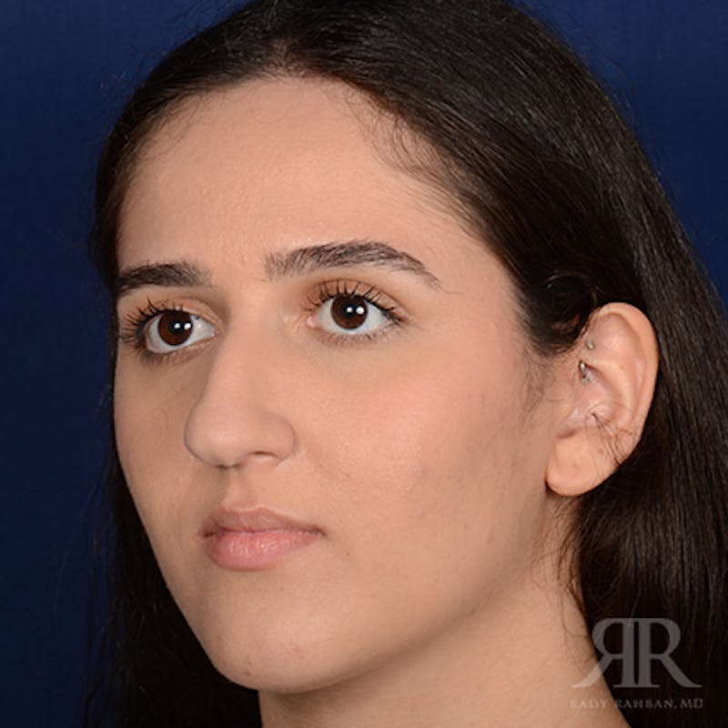 Female Rhinoplasty Before & After Gallery - Patient 314356 - Image 3