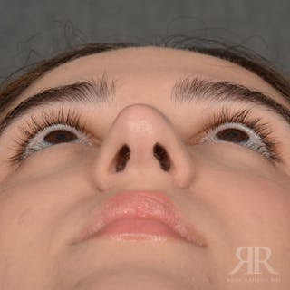 Female Rhinoplasty Before & After Gallery - Patient 314356 - Image 8