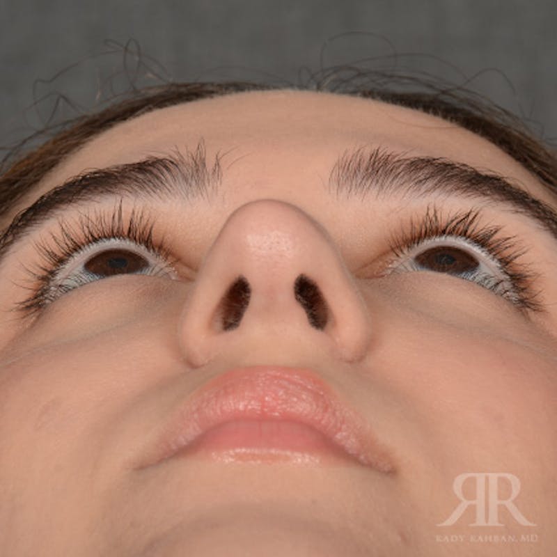 Female Rhinoplasty Before & After Gallery - Patient 314356 - Image 8