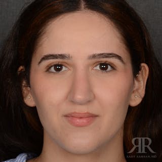 Female Rhinoplasty Before & After Gallery - Patient 314356 - Image 2