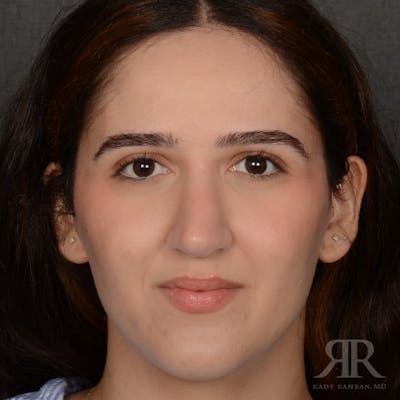 Female Rhinoplasty Before & After Gallery - Patient 314356 - Image 2