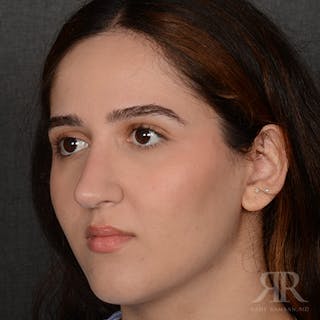 Female Rhinoplasty Before & After Gallery - Patient 314356 - Image 4