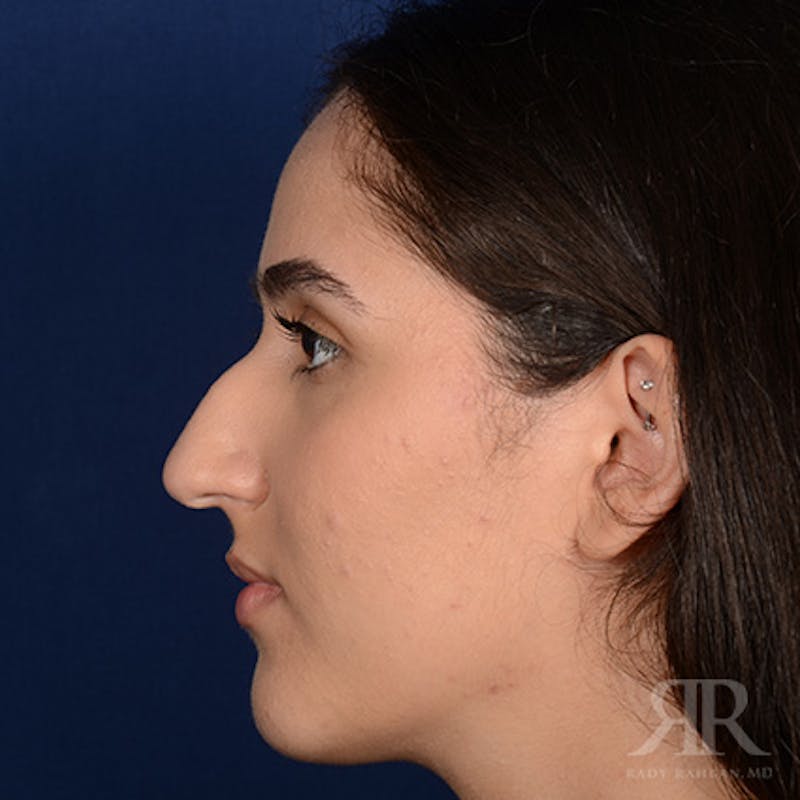 Female Rhinoplasty Before & After Gallery - Patient 314356 - Image 5
