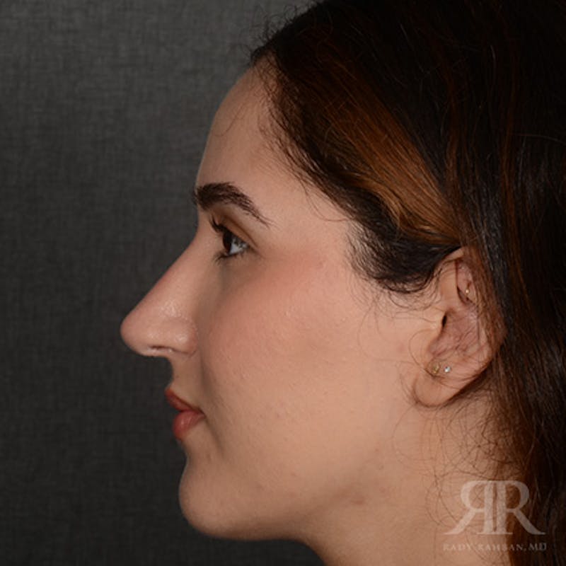 Female Rhinoplasty Before & After Gallery - Patient 314356 - Image 6