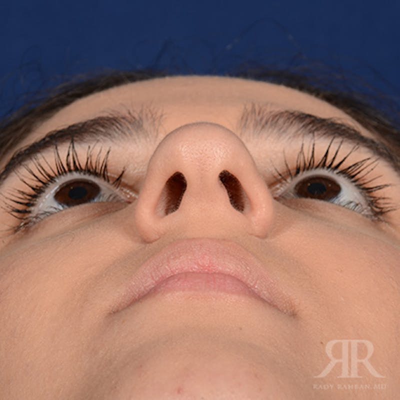 Female Rhinoplasty Before & After Gallery - Patient 314356 - Image 7
