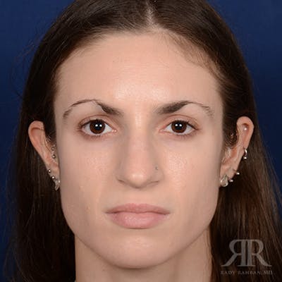 Female Rhinoplasty Before & After Gallery - Patient 206816 - Image 1