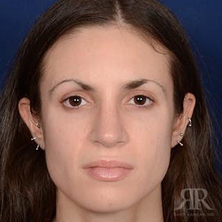 Female Rhinoplasty Before & After Gallery - Patient 206816 - Image 2