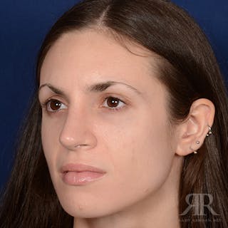 Female Rhinoplasty Before & After Gallery - Patient 206816 - Image 4