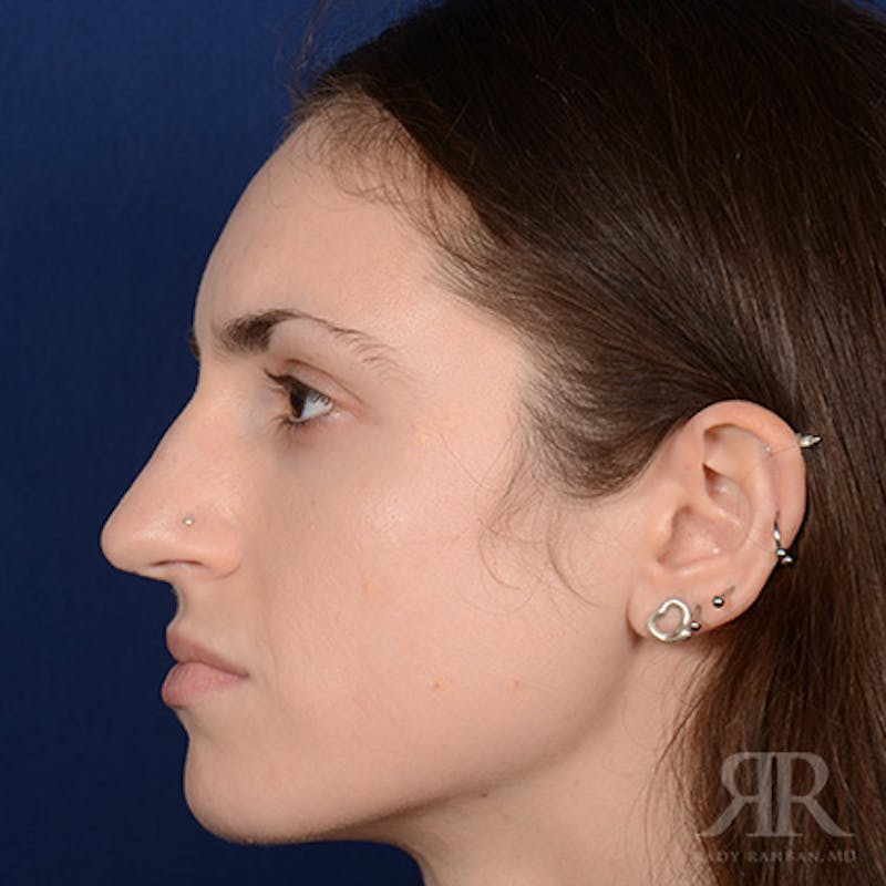 Female Rhinoplasty Before & After Gallery - Patient 206816 - Image 5