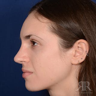 Female Rhinoplasty Before & After Gallery - Patient 206816 - Image 6