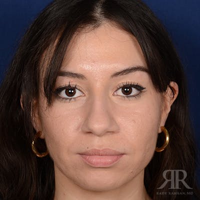 Female Rhinoplasty Before & After Gallery - Patient 706746 - Image 1