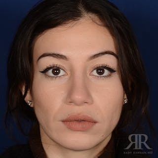 Female Rhinoplasty Before & After Gallery - Patient 706746 - Image 2