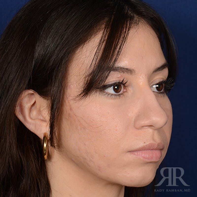 Female Rhinoplasty Before & After Gallery - Patient 706746 - Image 3