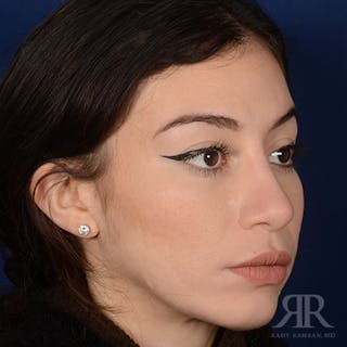 Female Rhinoplasty Before & After Gallery - Patient 706746 - Image 4