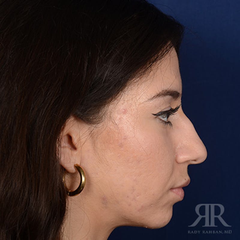 Female Rhinoplasty Before & After Gallery - Patient 706746 - Image 5