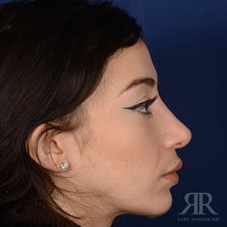 Female Rhinoplasty Before & After Gallery - Patient 706746 - Image 6