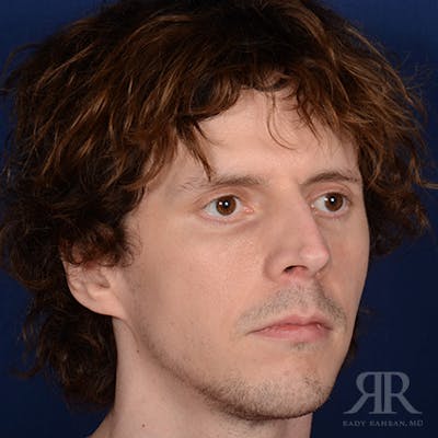 Male Rhinoplasty Before & After Gallery - Patient 230553 - Image 1