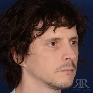 Male Rhinoplasty Before & After Gallery - Patient 230553 - Image 2