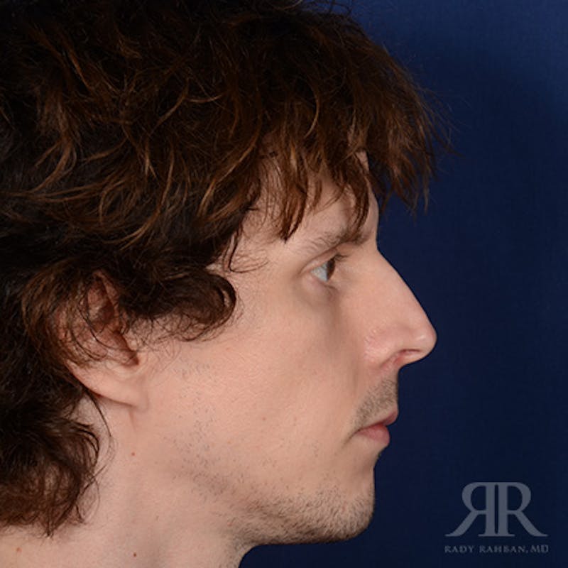 Male Rhinoplasty Before & After Gallery - Patient 230553 - Image 3